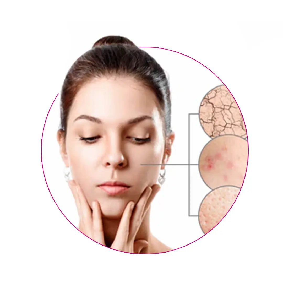 rosa_herbals_products_for_acne_prone_skin